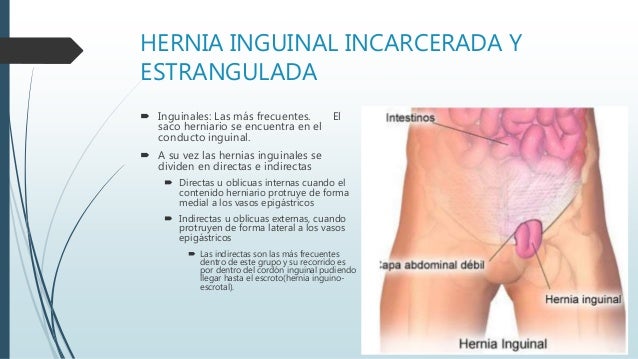 hernia encarcelada